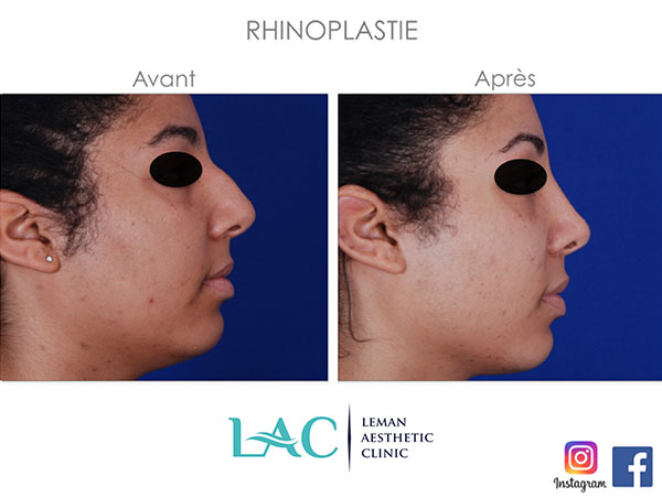 la rhinoplastie